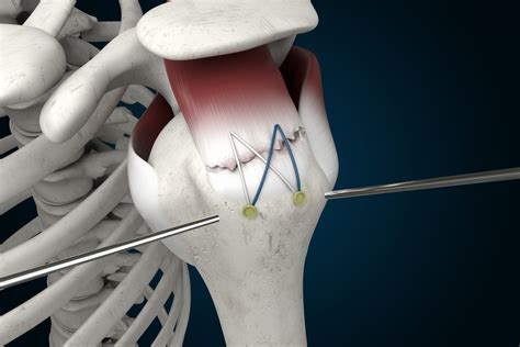 Arthroscopic Rotator Cuff Repair Mini Open Repair Biceps Tenodesis