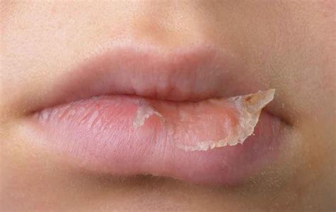 Eczema On The Lips Symptoms Causes And Treatment Seaside Medical