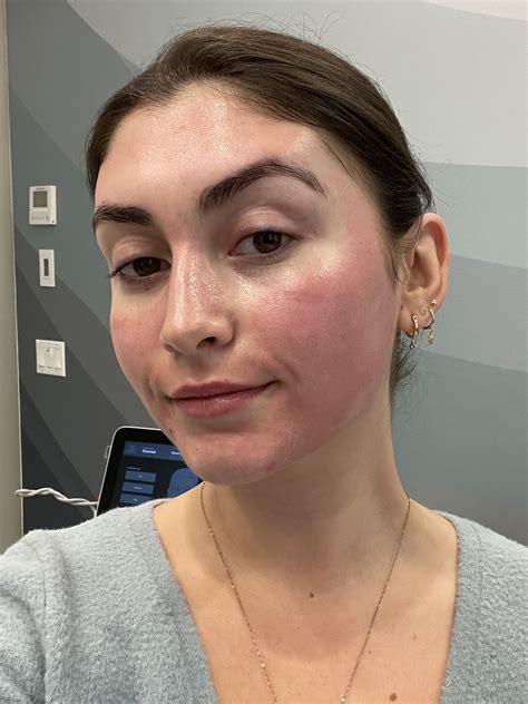 Clear Brilliant Laser Treatment Review With Photos Popsugar Beauty Uk