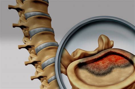 Tumores Vertebrales Y Espinales Dr Antonio Huete Allut Neurocirujano