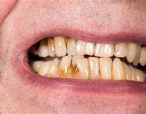 Receding Gums Know About Its Causes Symptoms And Treatment Healthwire