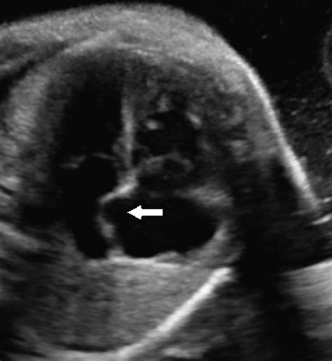 Foramen Ovale Aneurysm Transverse Ultrasound Image In 4ch