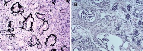 Nephronophthisis And Renal Cystic Dysplasia A Pathohistology Of