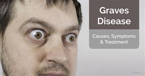 Graves Disease Causes Symptoms And Treatment