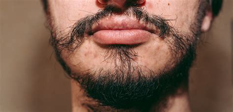 how to fix a patchy beard