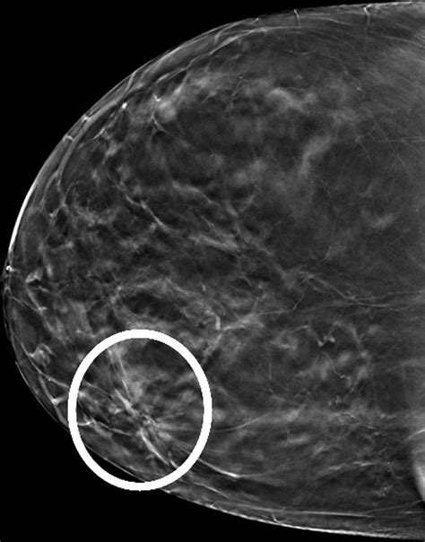 Digital Mammography Stereotactic Biopsy Versus Digital Breast
