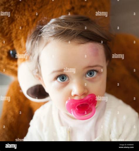 Bump On Forehead Hi Res Stock Photography And Images Alamy