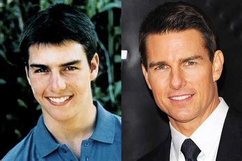 We bring you the same digital imaging technology that surgeons use to visualize plastic surgery results — all in a super easy to use app! Tom Cruise Plastic Surgery: Teeth, Nose Job, Hair, Facelift