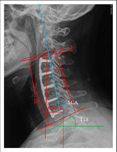 Lateral Radiograph Of The Cervical Spine Showing Measurements Of The