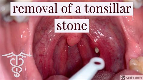 Tonsil Stones Removal The Best Place For All Your Healing Needs