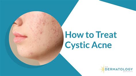 How To Treat Cystic Acne Youtube