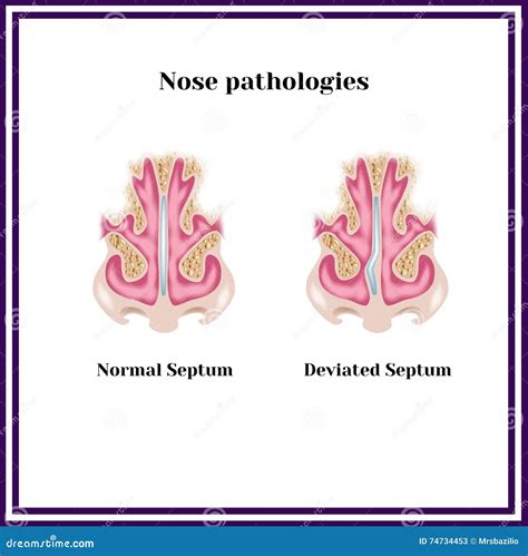 Deviated Septum Nasal Pathology Stock Illustration Illustration Of