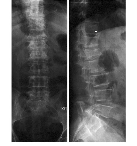 Preoperative Ap And Lateral X Ray Films With L1 Compression Fracture
