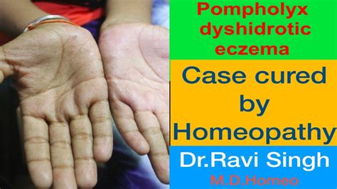 Pompholyx Or Dyshidrotic Eczema Homoeopathic Cured Case Youtube