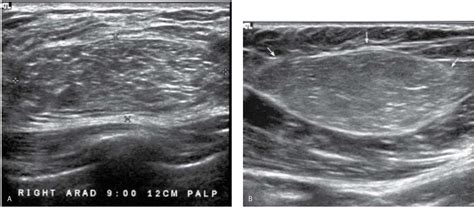 Evaluation And Imaging Features Of Benign Breast Masses Radiology Key