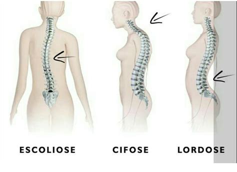 Escoliose Lordose E Cifose