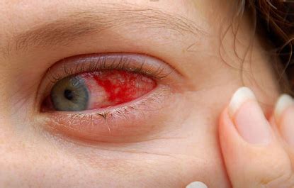 Viral marketing, the use of existing social networks to spread a marketing message. Viral Conjunctivitis | Théa