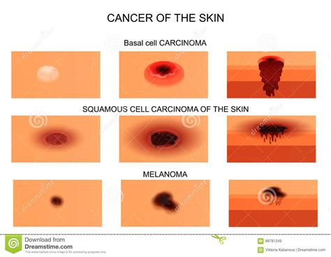 Images Of Different Types Of Skin Cancer