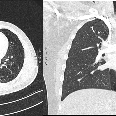 Ct Chest Showing Right Lower Lobe Cpam Download Scientific Diagram