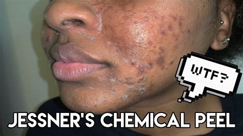 Chemical Peel Procedure Peeling Before And After Jessner Chemical