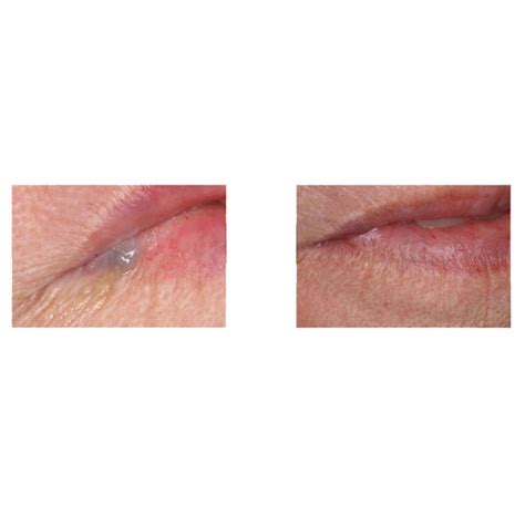 Lip Hemangioma Gallery Before And After Treatment Images