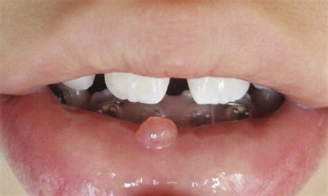 Mucocele ¿qué Es Y Cómo Se Cura Clínica Dental Ferrus And Bratos