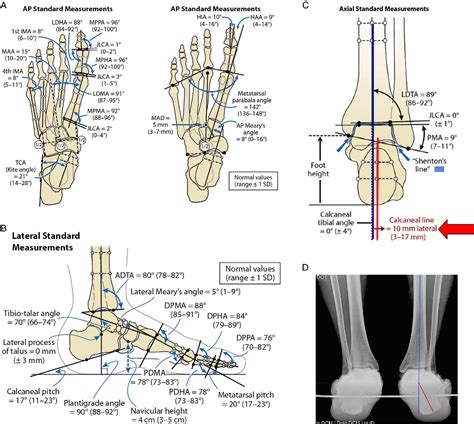 Figure 2 From Digital Planning For Foot And Ankle Deformity Correction