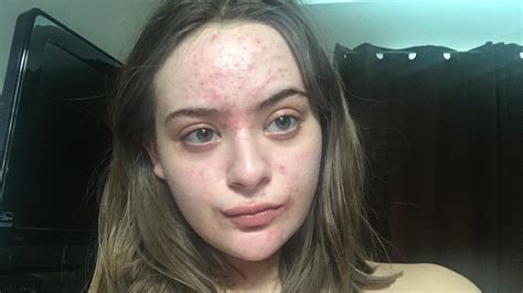 Very Sudden Massive Breakout All Over Face General Acne Discussion