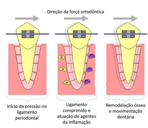 Dentes Moles Com O Aparelho Ortodôntico Ortodontia Descomplicada