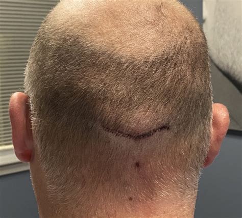One Day After Reduction Of Large Occipital Knob And Nuchal Ridges Dr