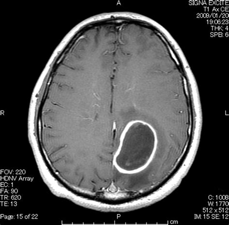 Position Dependent Right To Left Shunt Causing A Brain Abscess