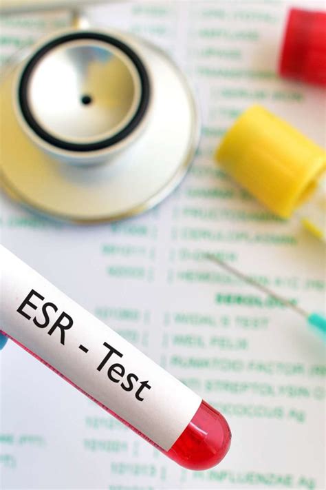 Repeat the test several times to check the stability of the results obtained. ESR test: Procedure, results, and risks