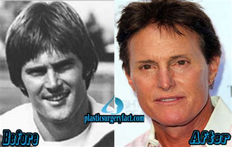 Bruce Jenner Plastic Surgery Before And After Photos