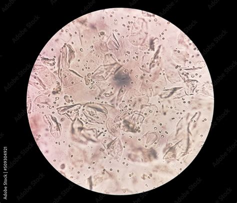 Microscopic Urine Examination Showing Hyaline Cast With Plenty Pus Cell