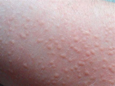 Home remedies you may try for postpartum hives. Effective ways to get rid of hives