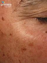 Skin Discoloration After Laser Treatment Photos