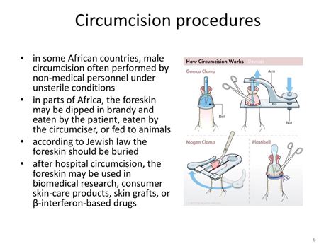 Ppt Circumcision And Vasectomy Powerpoint Presentation Free Download Id1457116