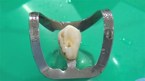 Operatoria Dental Y Endodoncia TÉcnicas Y Materiales15