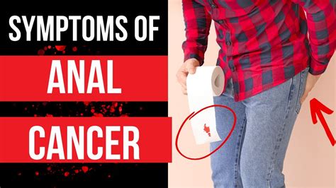 Doctor Explains SYMPTOMS OF ANAL CANCER Plus Risk Factors Diagnosis