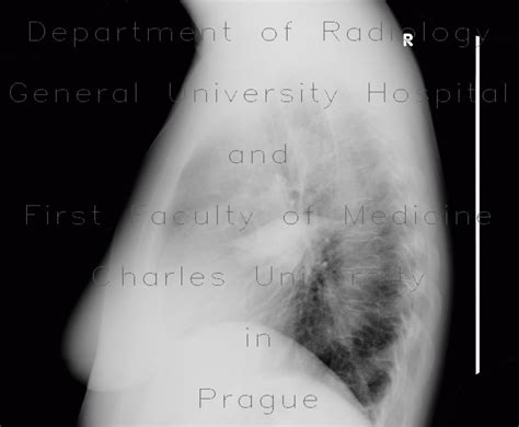 Radiology Case Pleural Effusion Loculated Fissure