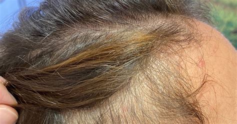 Alopecia Con Patrón Femenino Su Importancia En Medicina Y Cirugía Estética