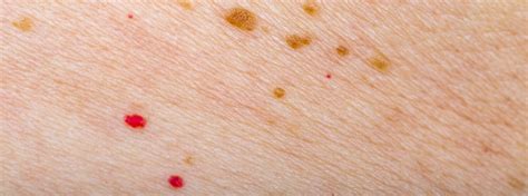 Tiny Red Blood Spots On Skin Pictures Petechiae Causes Treatments