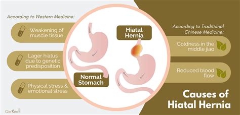 Discover How Chinese Medicine For Hiatal Hernia Can Help Ginsen