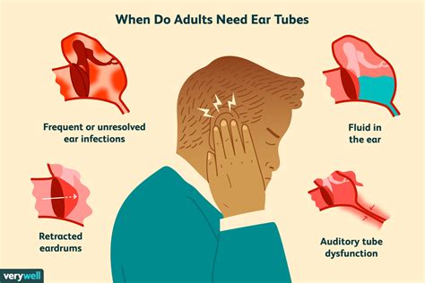 Ear Tubes For Adults Preparation Procedure Recovery