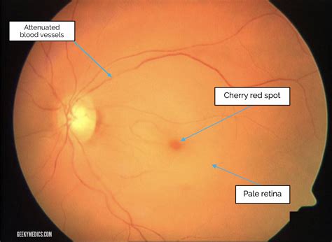 Fundoscopic Appearances of Retinal Pathologies | Geeky Medics