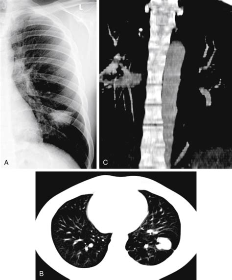 Solitary Pulmonary Nodule Radiology Key