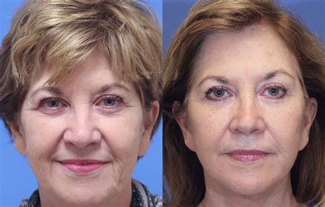 Blepharoplasty Before And After Savannah Facial Plastic Surgery