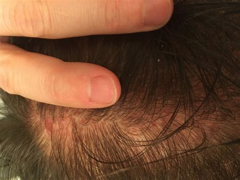 How To Remove Hair Dye From Scalp But Not Hair - How To Get Splat Hair Dye Off Scalp