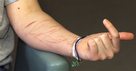 Social media is one reason my teen patients are cutting themselves