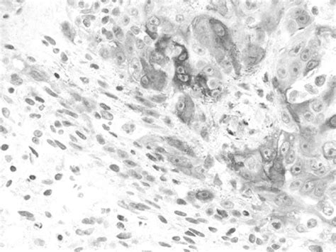Acantholytic Cells In An Invasive Squamous Cell Carcinoma The